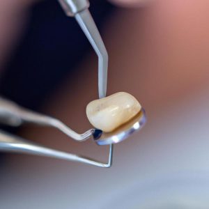 Jak usunąć kamień z zębów?